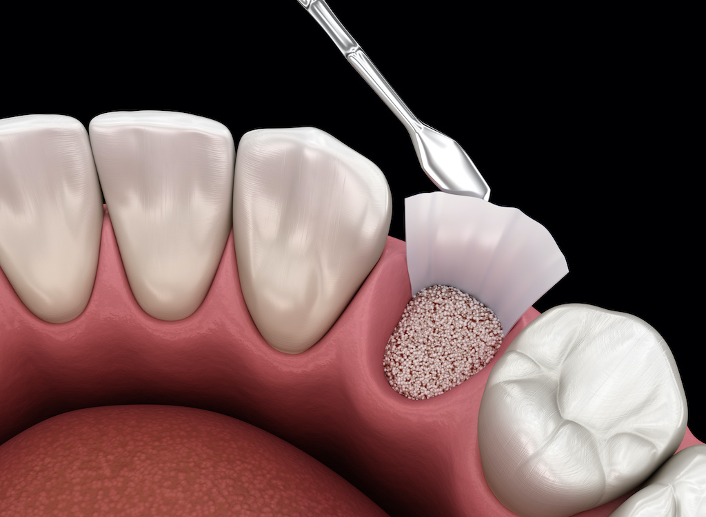 Bone Grafting | Midwest Oral Surgery