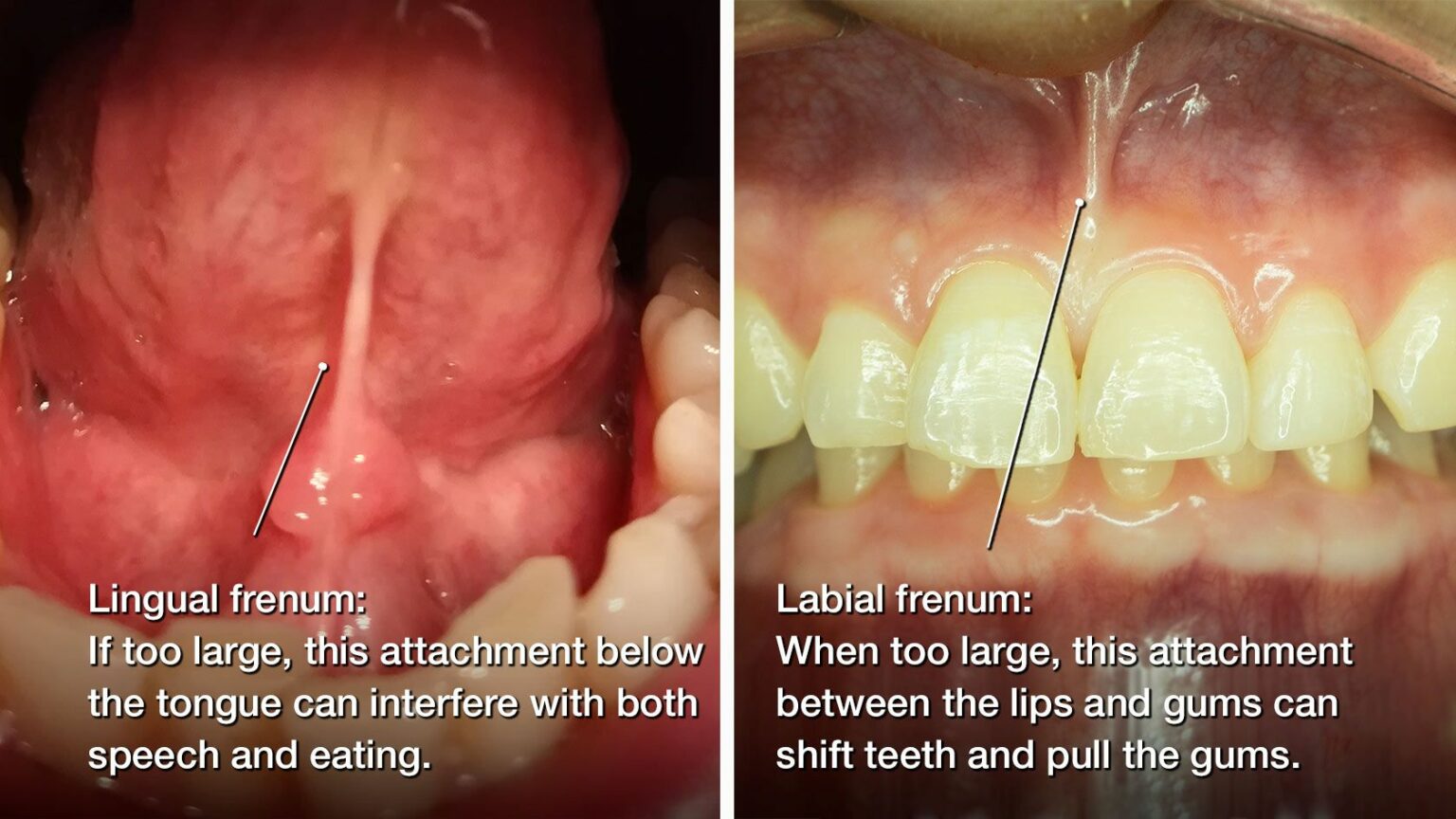 Frenectomy St Louis Midwest Oral And Maxillofacial Surgery