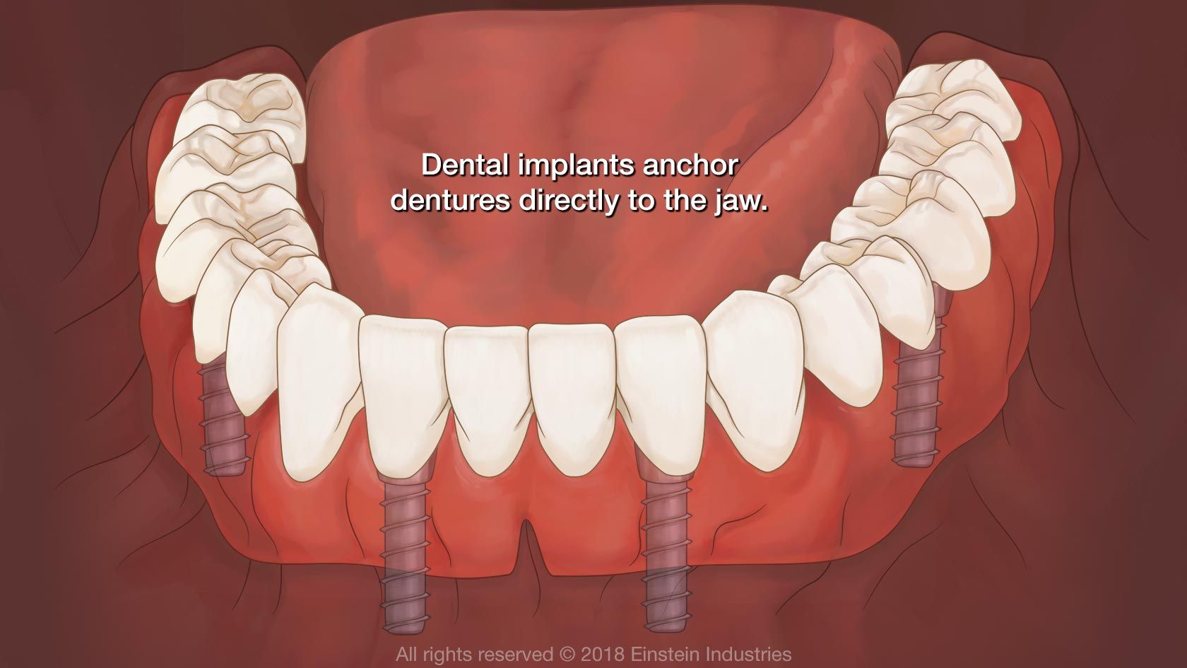 Dental implants anchor dentures directly to the jaw