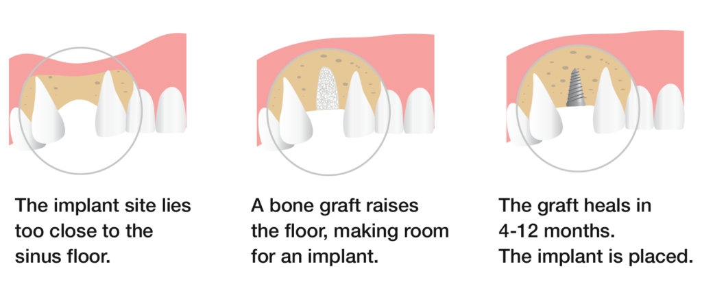 Implant infographic that shows the bone graft